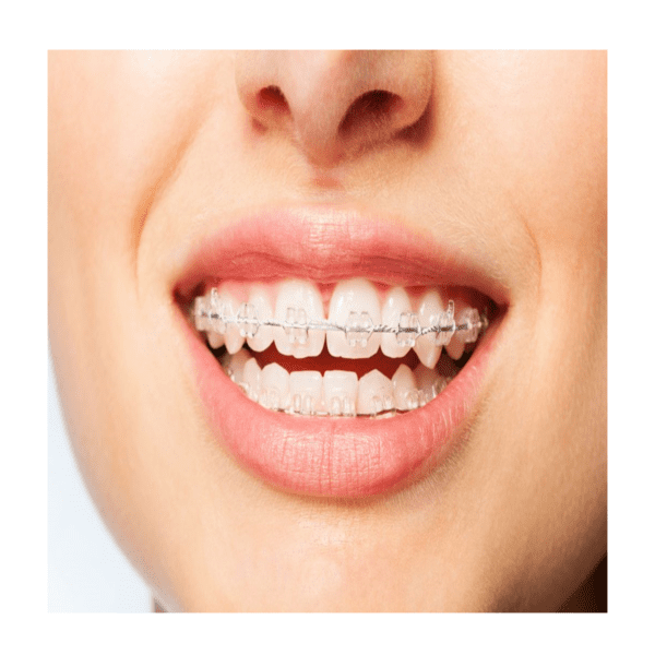 Orthodontics - Dental Braces